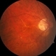 Lacquer Cracks in Pathologic Myopia